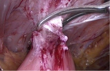 Лапароскопическая герниопластика вентральная грыжа thumbnail