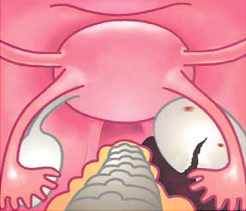 Тканевой компонент в кисте яичника thumbnail