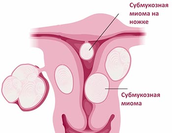 Лапароскопия при субмукозной миома матки