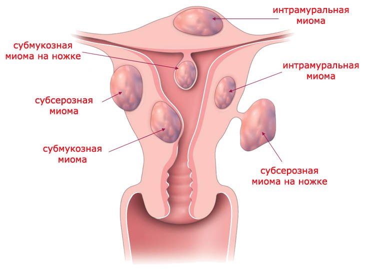 Константин пучков стоимость операции по удалению миомы матки