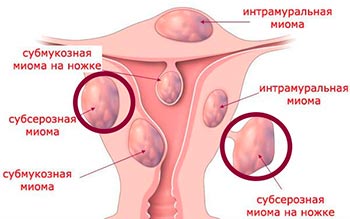 Операция по удалению субсерозной миомы матки