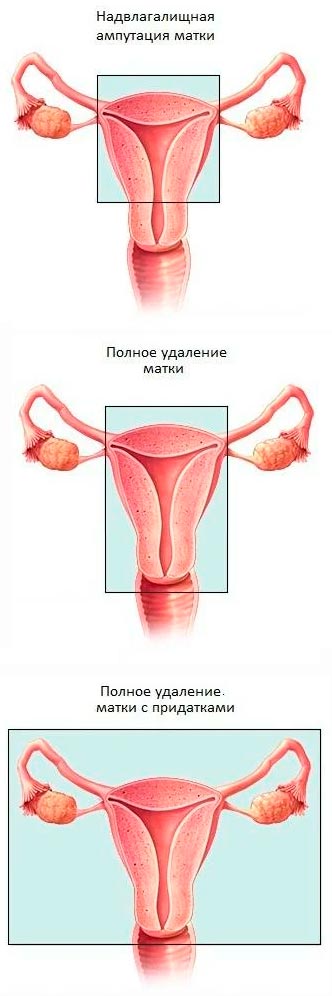 В каких случаях при миоме матки удаляют яичники