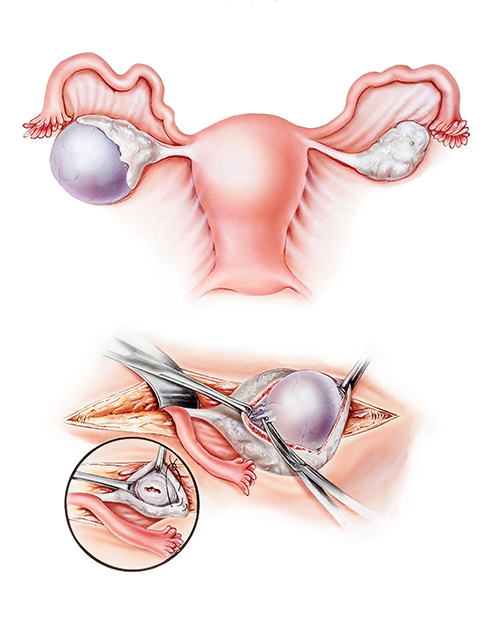 Лапароскопия удаление труб и кист яичников