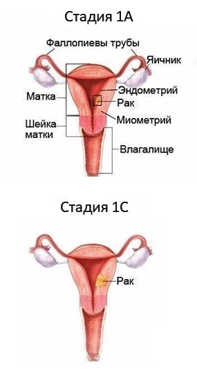 Рак матки 1 стадии прогнозы