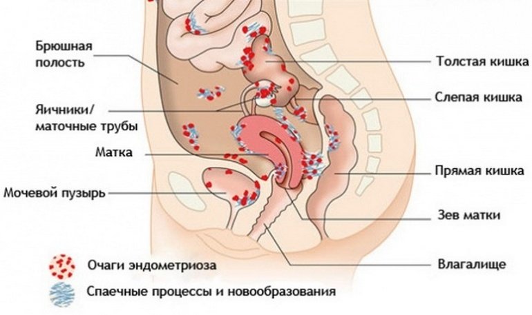 Эндометриоз матки с геморрагическим синдромом