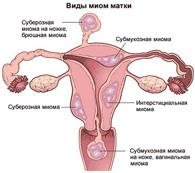 Размер матки в неделях беременности при миоме thumbnail