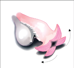 Точечная эндокоагуляция брюшины фимбриального отдела маточной трубы