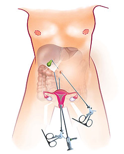 жкб операция