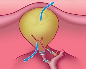 Этапы лапароскопической холецистэктомии — клипирование пузырного протока и артерии