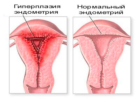 Атипическая гиперплазия эндометрия матки - признаки и лечение. - Хирург К.  В. Пучков