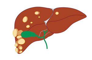 Киста правой доли печени рисунок 1