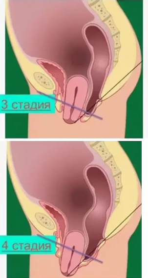 стадии пролапса гениталий