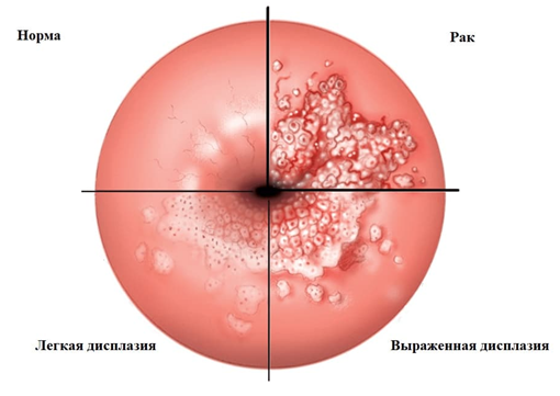 Дисплазия шейки матки 2 степени - лечение, симптомы, операция. - Хирург ...