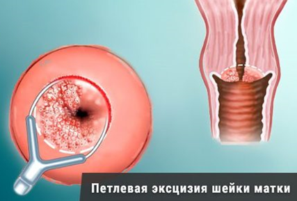 Петлевая эксцизия шейки матки