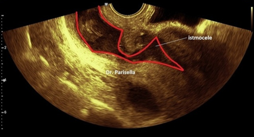 Ниша в области рубца на матке