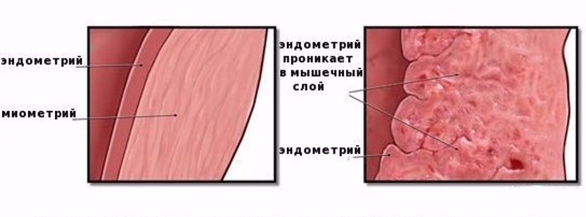 Эндометрий 1 мм. Миометрий ячеистой структуры. Структура эндометрия однородная. Эндометриоидная шейки матки.