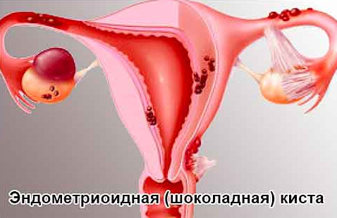 Методы диагностики эндометриоидной кисты яичника