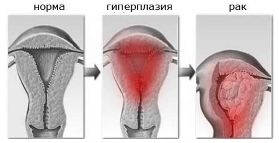 Очаговая гиперплазия эндометрия матки - признаки, лечение, операция. -  Хирург К. В. Пучков