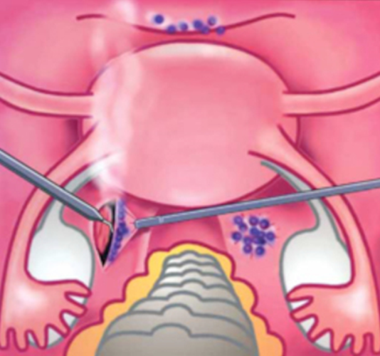 Иссечение очагов наружного эндометриоза в области крестцово-маточных связок