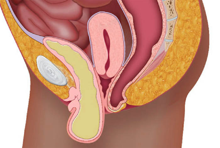 Опущение матки (пролапс) — причины, симптомы и лечение заболевания | Клиника «Альфа-Центр Здоровья»