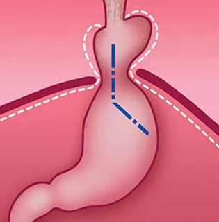 Перемещение части желудка в грудную полость и изменение угла Гиса при грыже пищеводного отверстия диафрагмы (схема).