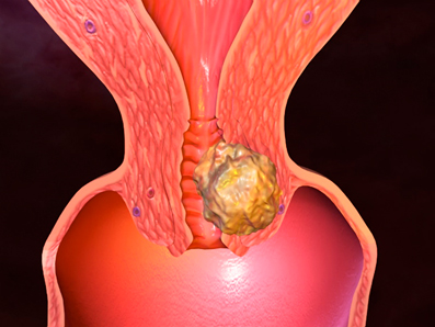Прогноз при плоскоклеточном неороговевающем раке шейки матки